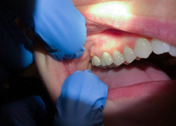 Best Emergency Wisdom Teeth Removal in Maplewood, WA